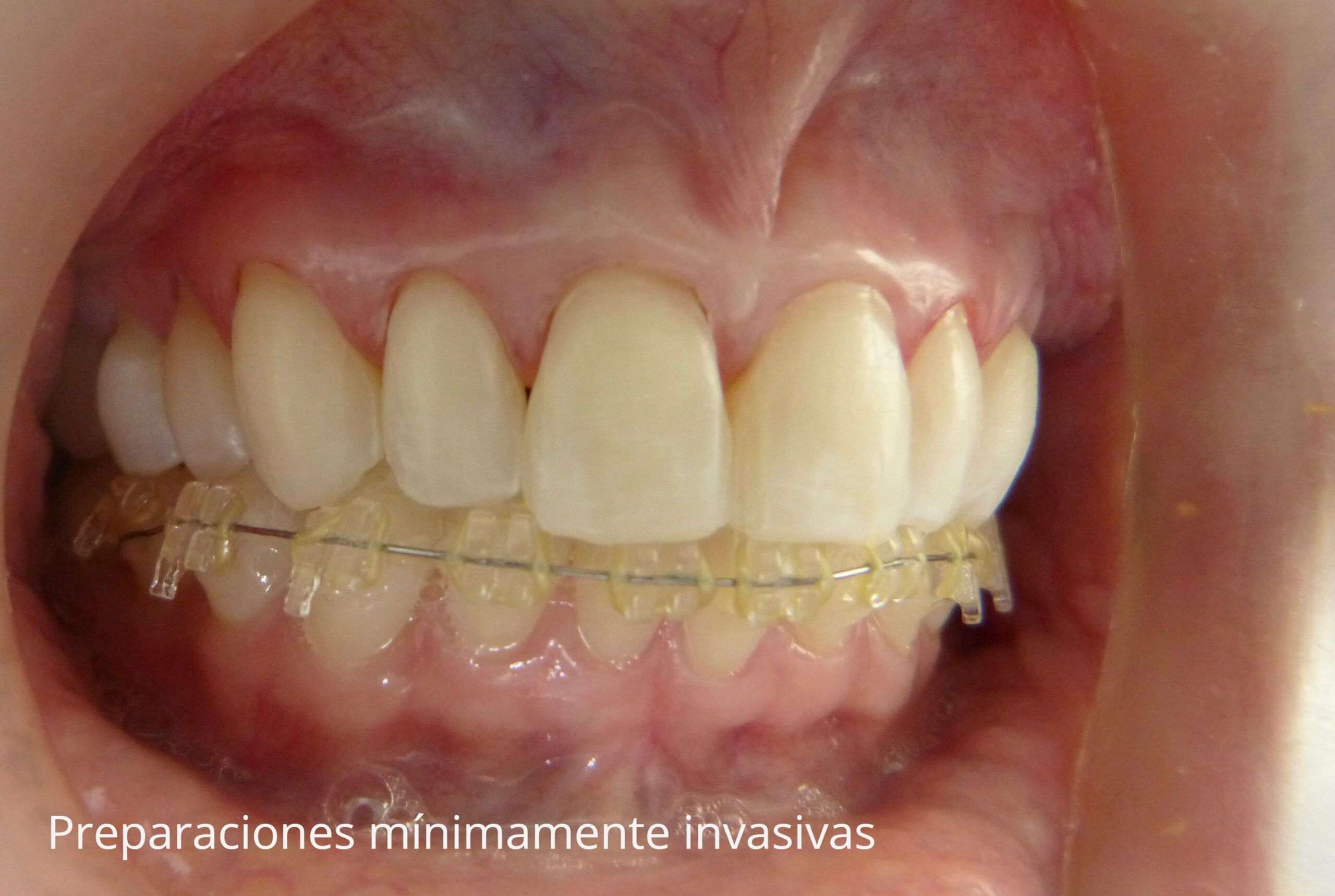 2.Preparaciones minimamente invasivas-min 2.Preparaciones minimamente invasivas min